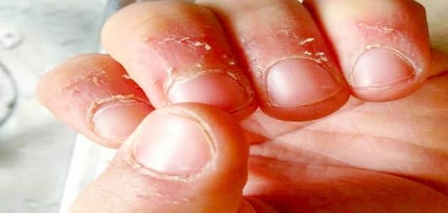 Σκασμένο δέρμα γύρω από τα νύχια στα παιδιά - άρθρο