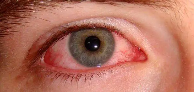 أسباب ظهور شعيرات دموية في العين