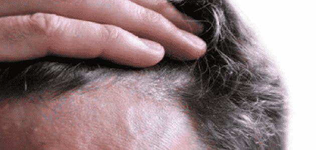 أمراض الشعر المعدية والوقاية منها