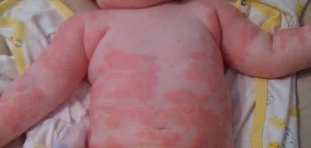 احمرار الجلد مع حرارة عند الأطفال
