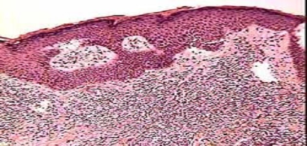 اسباب التهاب الخلايا اللمفاوية