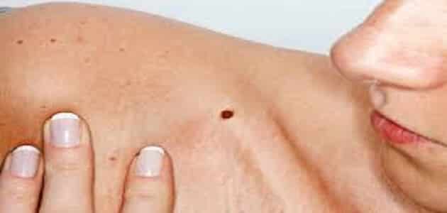 اعاعراض سرطان جلد الوجه وطرق علاجهاراض سرطان جلد الوجه وطرق علاجها