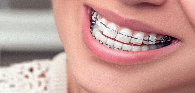 الم تقويم الأسنان بعد التركيب