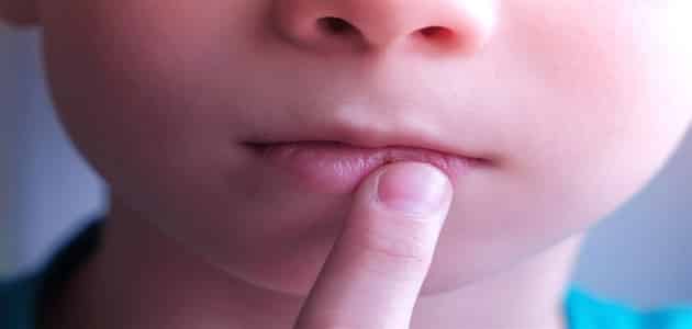 شكل هربس الفم عند الاطفال