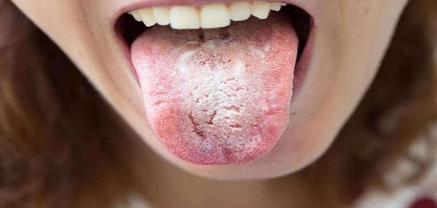 طرق التخلص من بكتيريا الفم