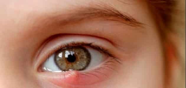 طريقة علاج شحاذ العين الداخلي والخارجي
