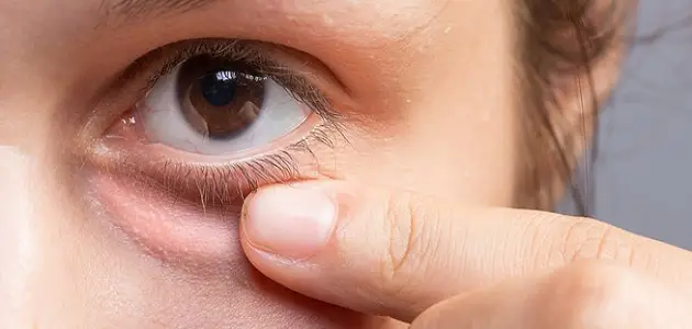 علاج التهاب الجفن السفلي للعين
