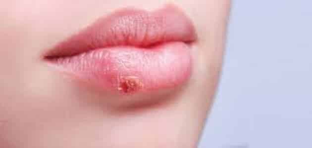 علاج حبوب الهربس حول الفم