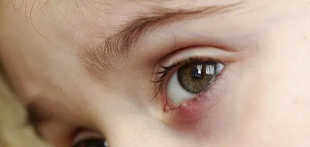 علاج شحاذ العين عن الأطفال