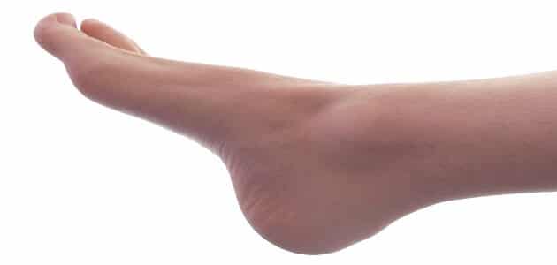 علاج فقاعات مائية في باطن القدم