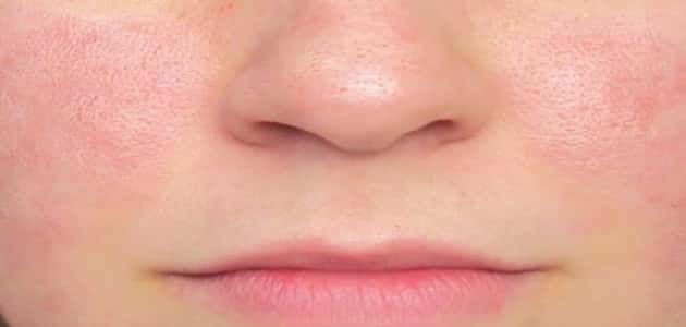 كيفية علاج وردية الوجه نهائيا