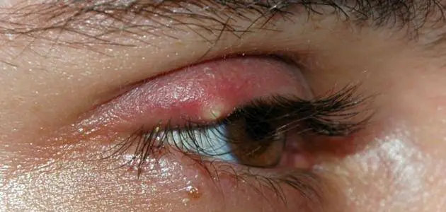 أسباب ظهور حبوب داخل جفن العين العلوي عند الأطفال
