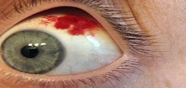 علاج جرح جفن العين من الداخل