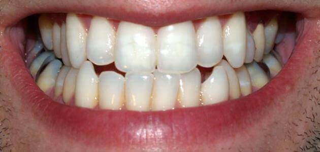 موضوع عن الأسنان وكيفية الحفاظ عليها من التسوس