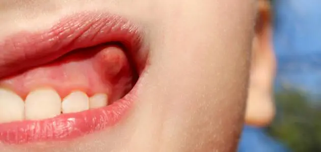 هل خراج الأسنان يسبب التهاب الحلق