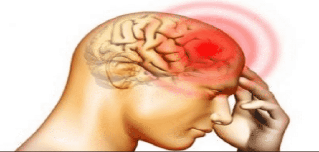 أعراض جلطة جذع المخ وعلاجها