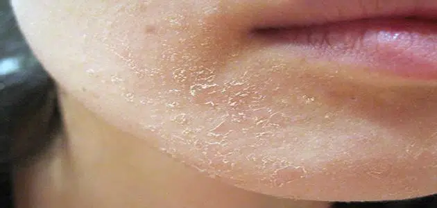 قشور الوجه بعد التقشير الكيميائي