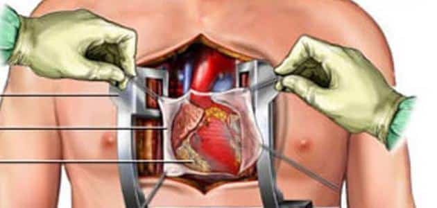 هل عملية قسطرة القلب خطيرة