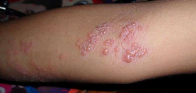 أمراض الجلد الفيروسية