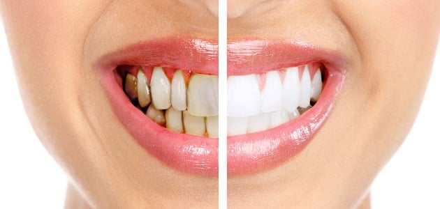 علاج تسوس الاسنان الامامية