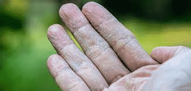 أسباب تقشر جلد الأصابع عند الرجال
