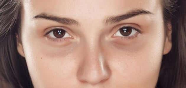 الهالات السوداء حول العين أسباب الظهور وطرق العلاج