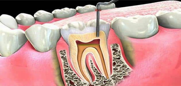 علاج الم عصب الاسنان بالبيت