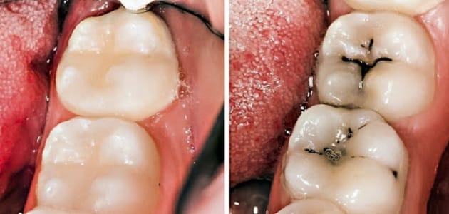 طريقة التخلص من تسوس الأسنان في يوم واحد