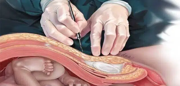 أضرار الولادة القيصرية على المدى البعيد