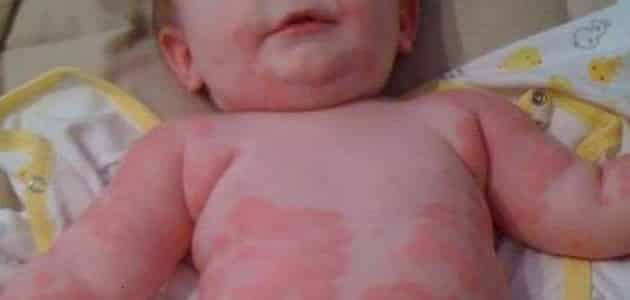 أعراض حساسية لبن الأم عند الرضع