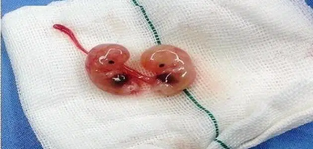 شكل اجهاض الجنين في الشهر الاول