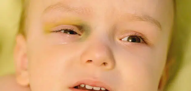 علاج كدمات العين عند الأطفال