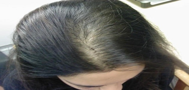 امبولات لتساقط الشعر الوراثي