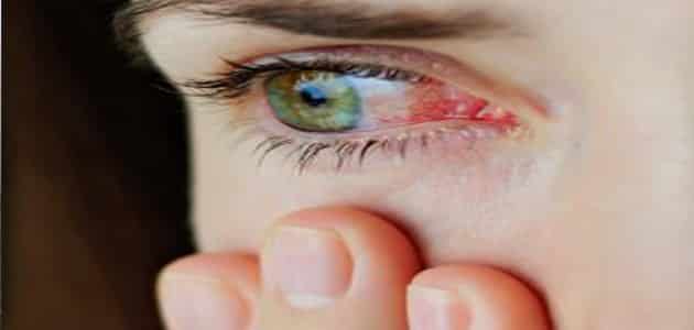 علاج ذبابة العين في المنزل