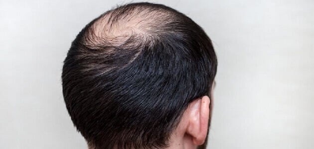 كيف أعرف تساقط الشعر الوراثي