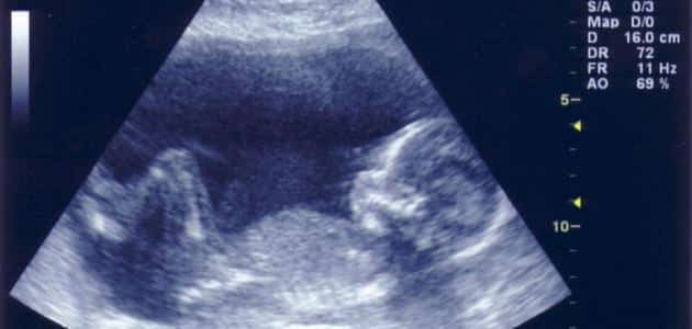 معرفة نوع الجنين في الشهر الرابع بدون سونار