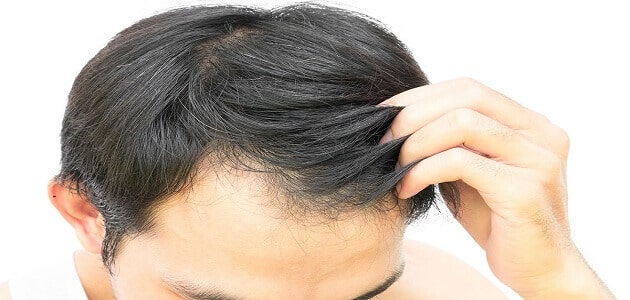 هل يوجد علاج لتساقط الشعر الوراثي