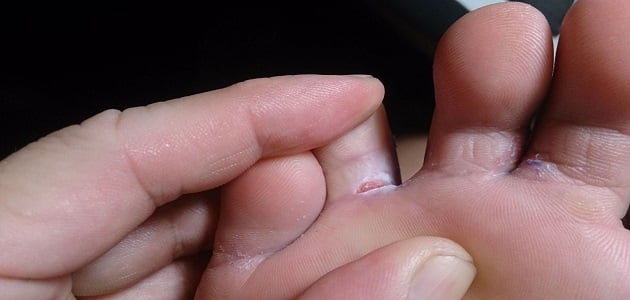 علاج الذبيحة بين أصابع القدمين في المنزل