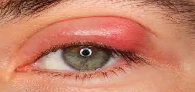 علاج تورم العين بسبب ضربة