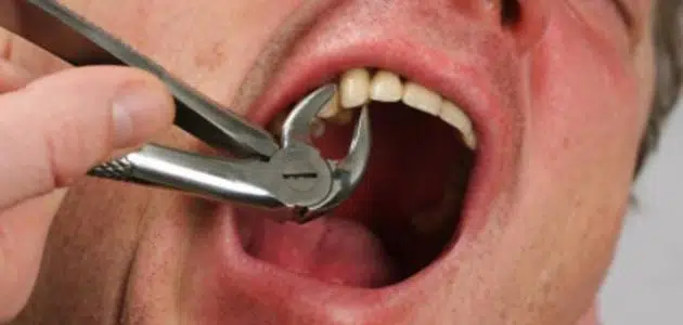 تفسير حلم خلع الأسنان للعزباء