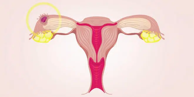 هل يظهر الحمل خارج الرحم في تحليل الدم