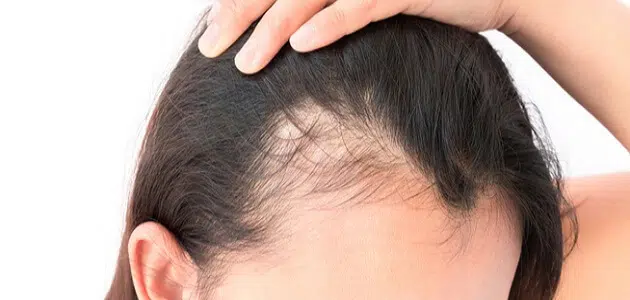 دواء إنبات الشعر في مقدمة الرأس
