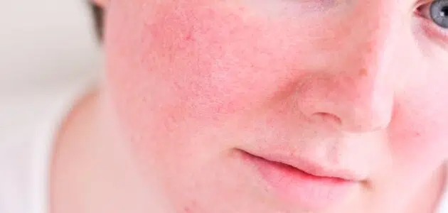 علاج احمرار الوجه بسبب استخدام كريم