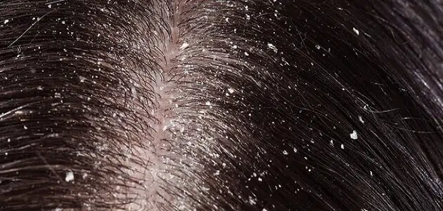 علاج القشرة اللاصقة في الشعر