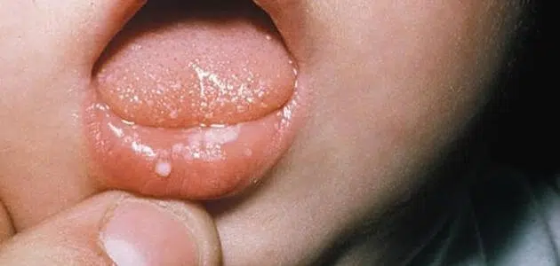 علاج فطريات الفم عند الرضع عمر شهرين