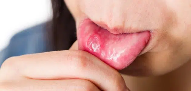 علاج فطريات الفم من الصيدلية
