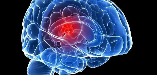 نسبة الشفاء من نزيف المخ
