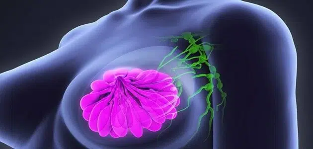 هل يعود سرطان الثدي بعد الشفاء
