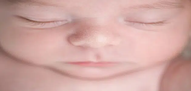 حبوب بيضاء في وجه الرضيع
