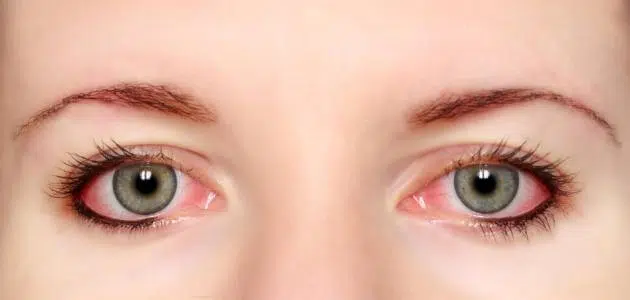هل حساسية العين تؤثر على النظر
